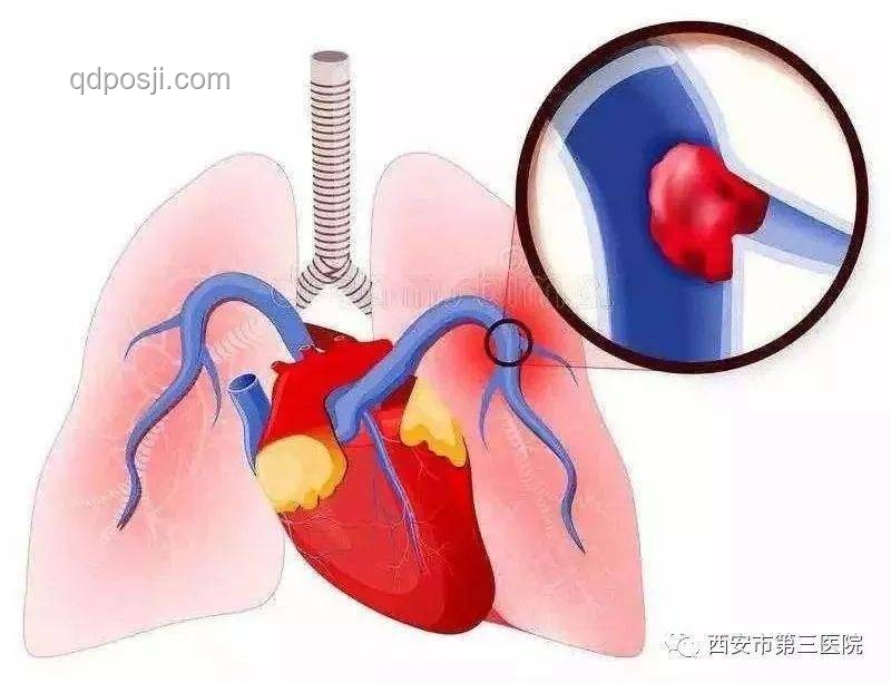 男子不當(dāng)運動拉伸與肺動脈栓塞風(fēng)險對比分析 男子不當(dāng)運動拉伸與肺動脈栓塞風(fēng)險對比分析