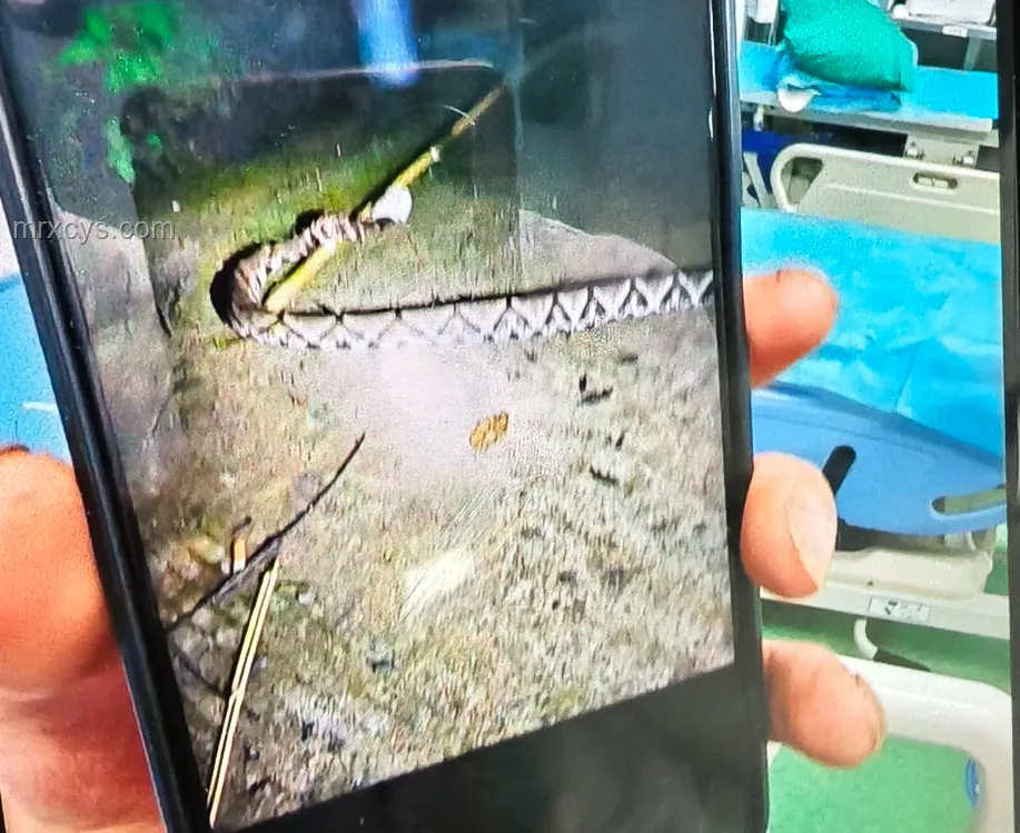 毒蛇咬傷案例對比:凝血功能崩潰的警示 毒蛇咬傷案例對比:凝血功能崩潰的警示