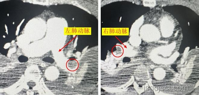 女子長途飛行后心跳驟停，肺栓塞風(fēng)險(xiǎn)需警惕